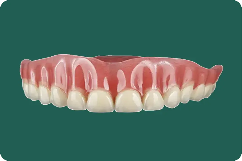 Implant-supported overdenture being fitted onto its supporting attachments