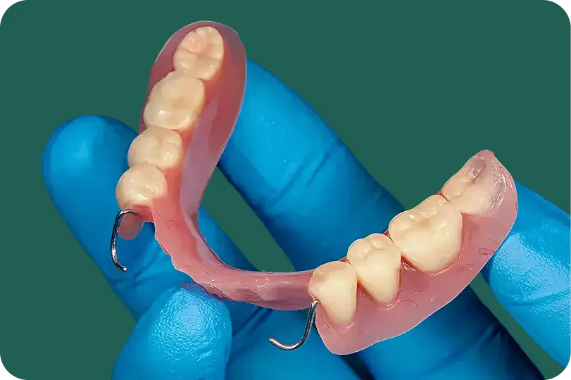 Overdenture attached to implant abutments for a secure, removable fit