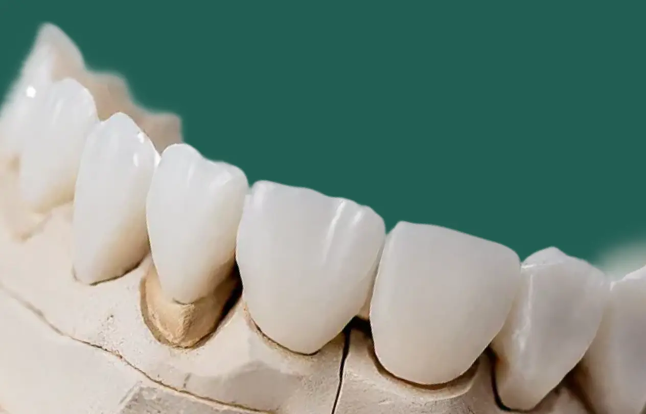 Zirconia crown shown with thickness measurements marked for a scanner-first digital workflow