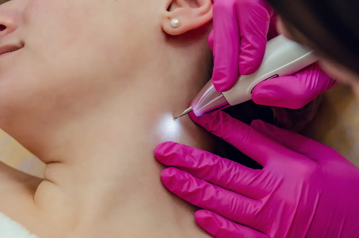 Skin Tag Removal