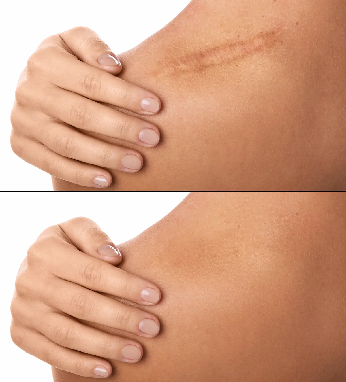Scar Tissue Removal