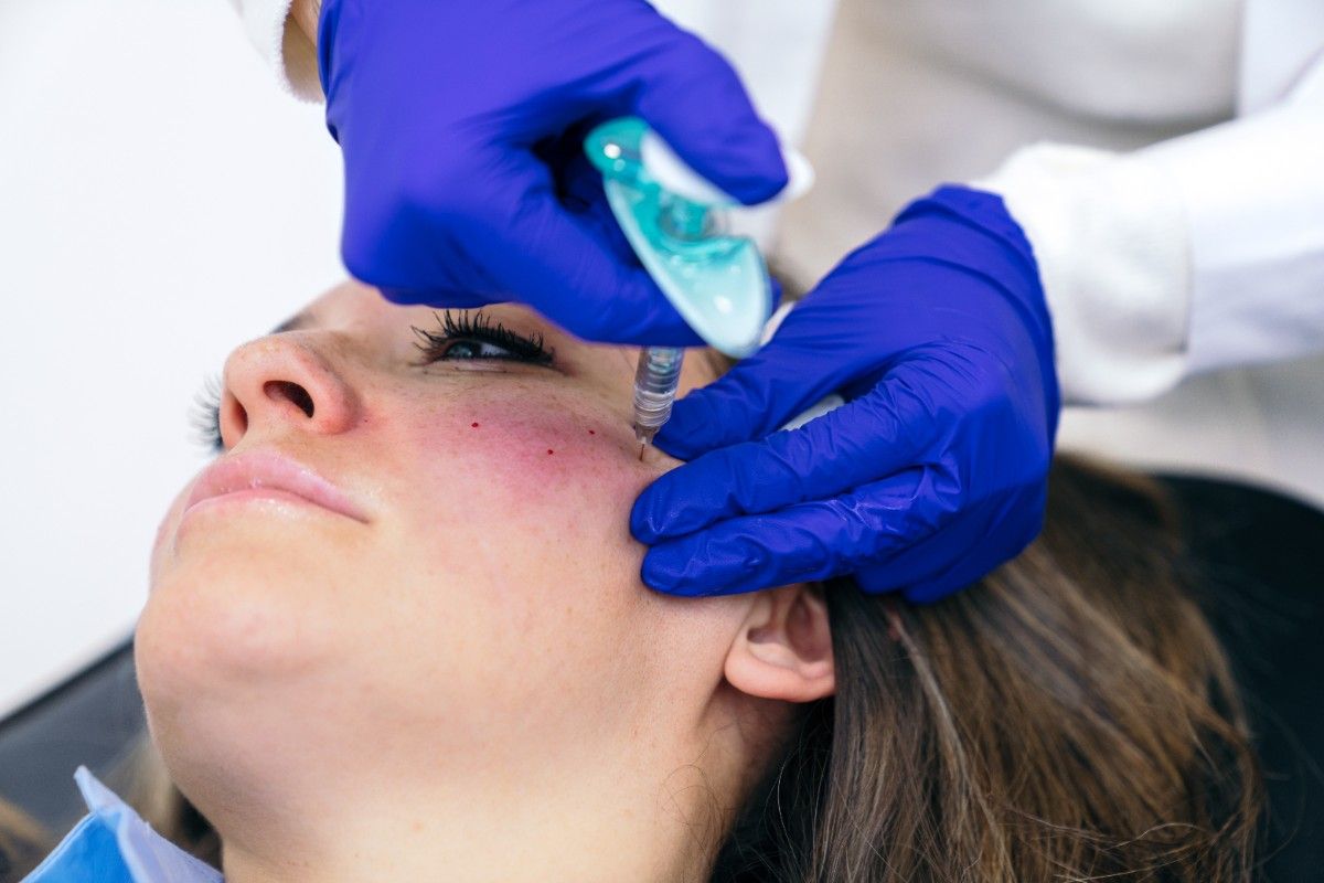 microneedling acne treatment