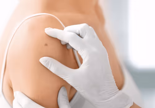 Why Are Regular Skin Checks Essential for Detecting Skin Cancer Early?