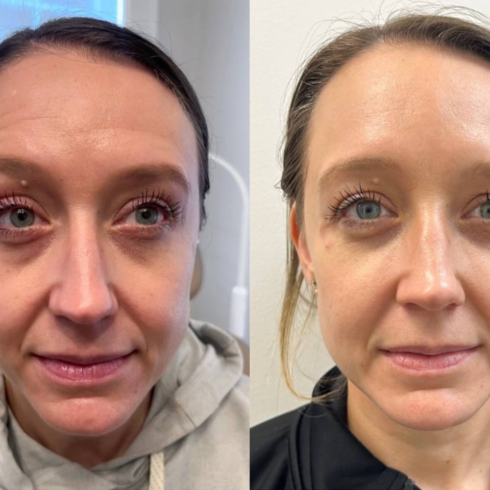 Side-by-side comparison of a woman's face before and after a skin treatment, showing reduction in under-eye darkness and smoother complexion.