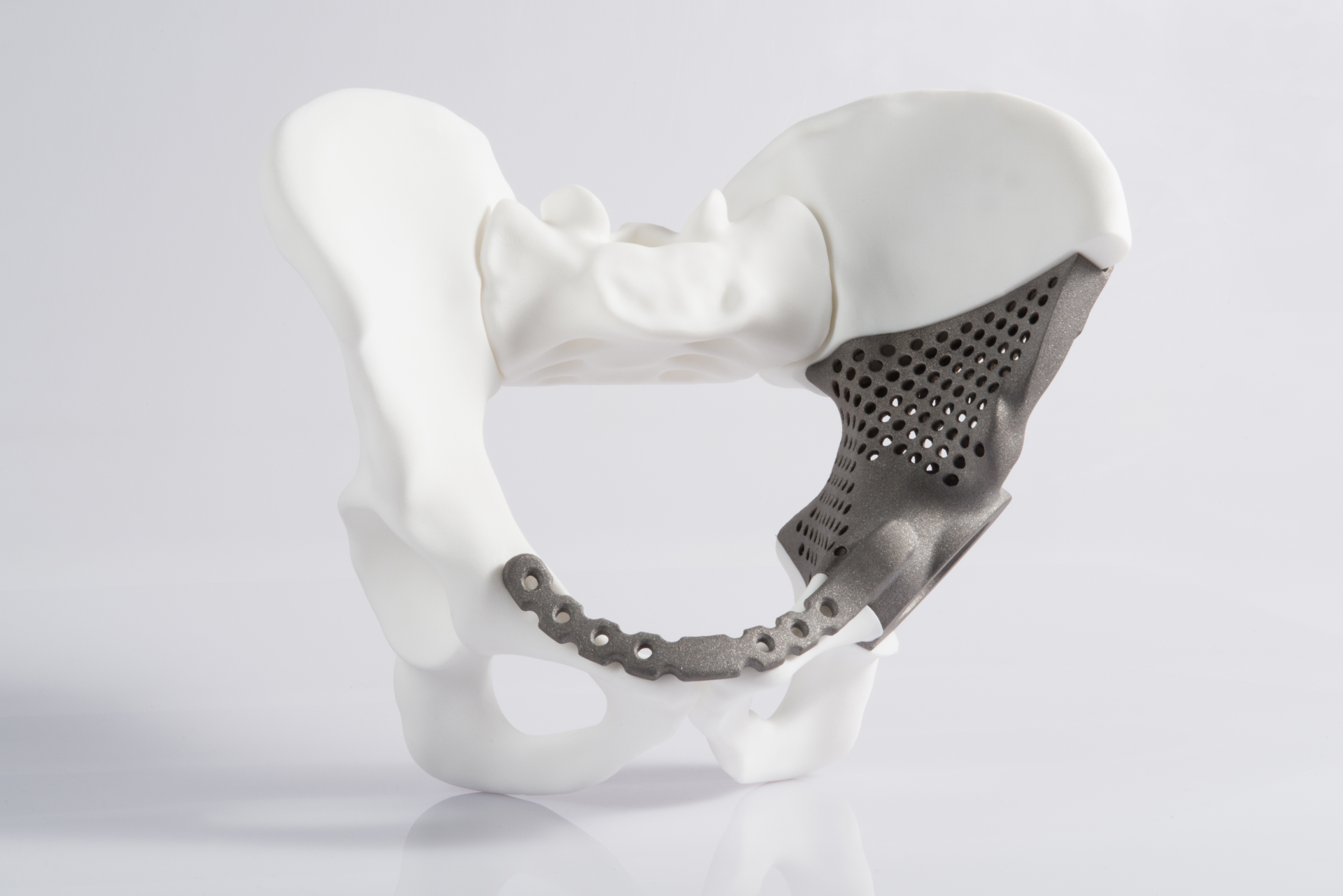 Beckenmodell mit integriertem 3D gedruckten Implantat.
