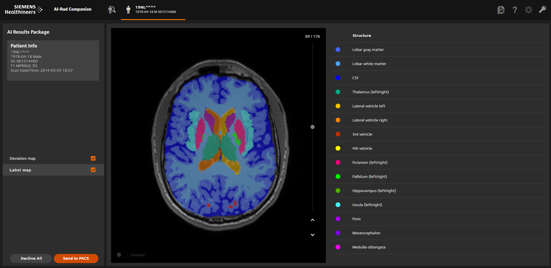 Bildschirm mit Ansicht eines Kopf-MRTs von oben in AI-Rad Companion Software.