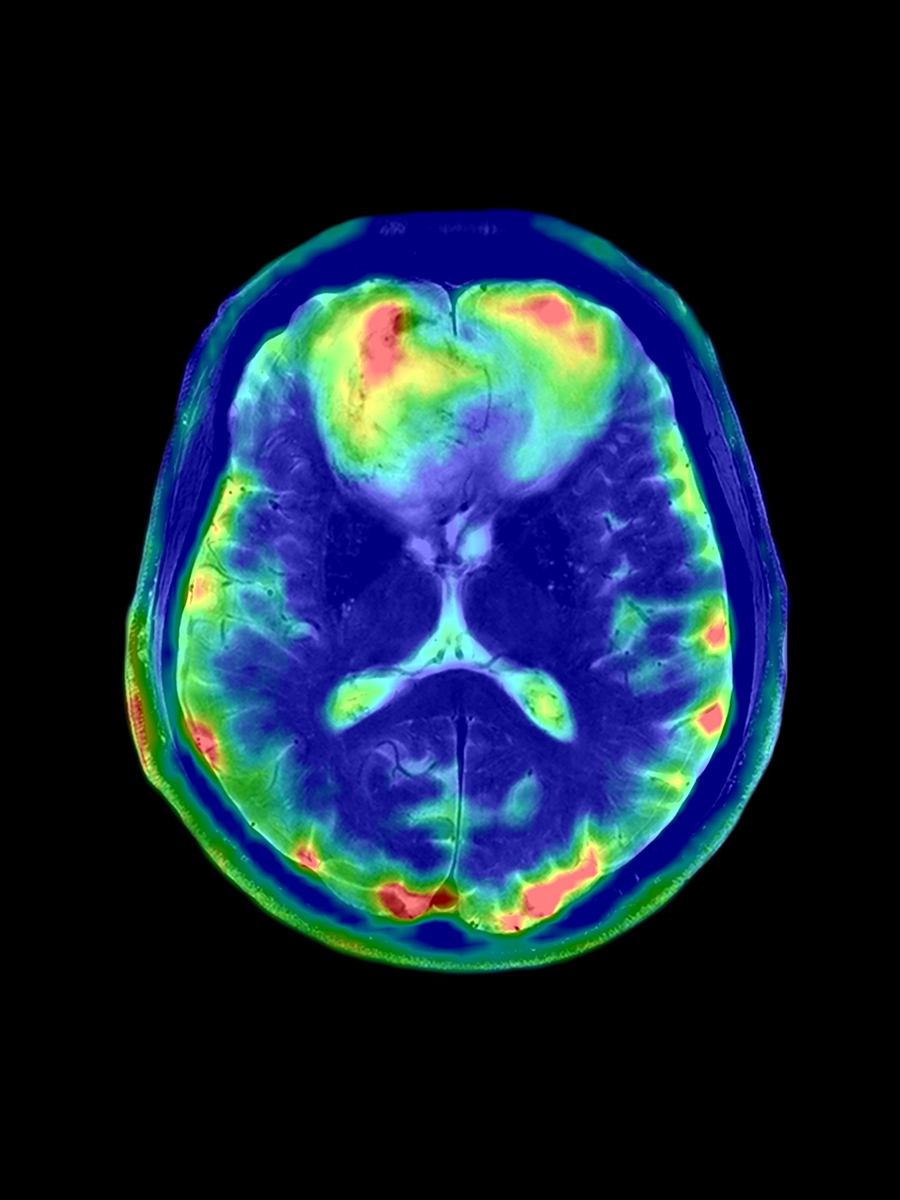 MRT Bild eines Kopfes von oben.