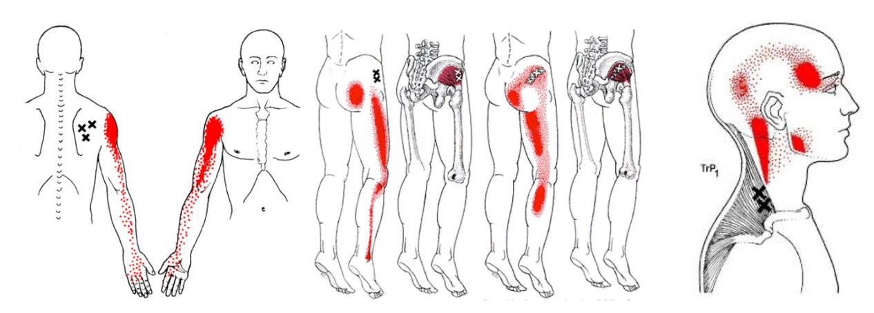 dry needling plekken