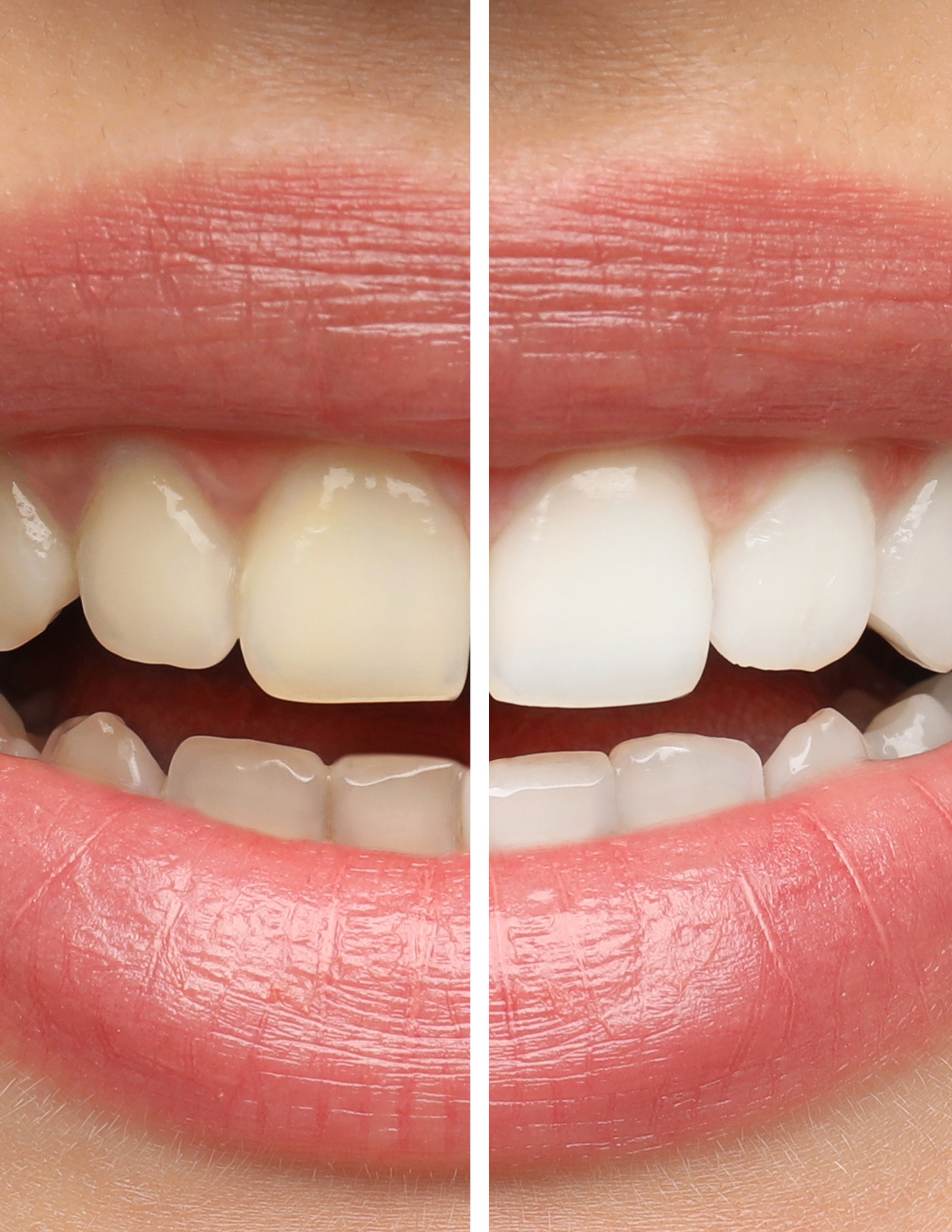 Wie lange hält ein Zahnbleaching wirklich?
