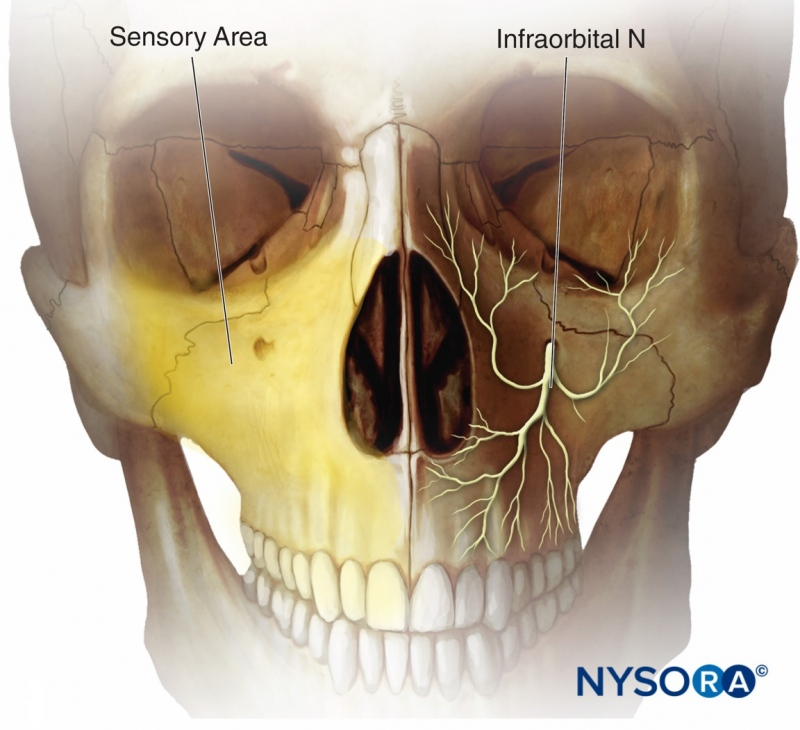 Blokada Nerwu Trójdzielnego Gałąź Szczękowa: Nerw Podoczodłowy