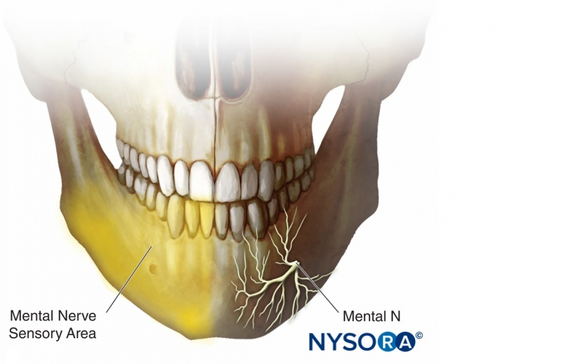 Blokada nerwu trójdzielnego gałąź żuchwowa: nerw bródkowy