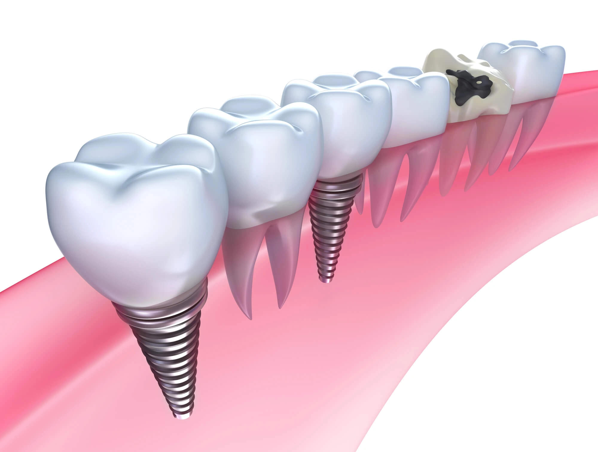 dental implants Jupiter FL