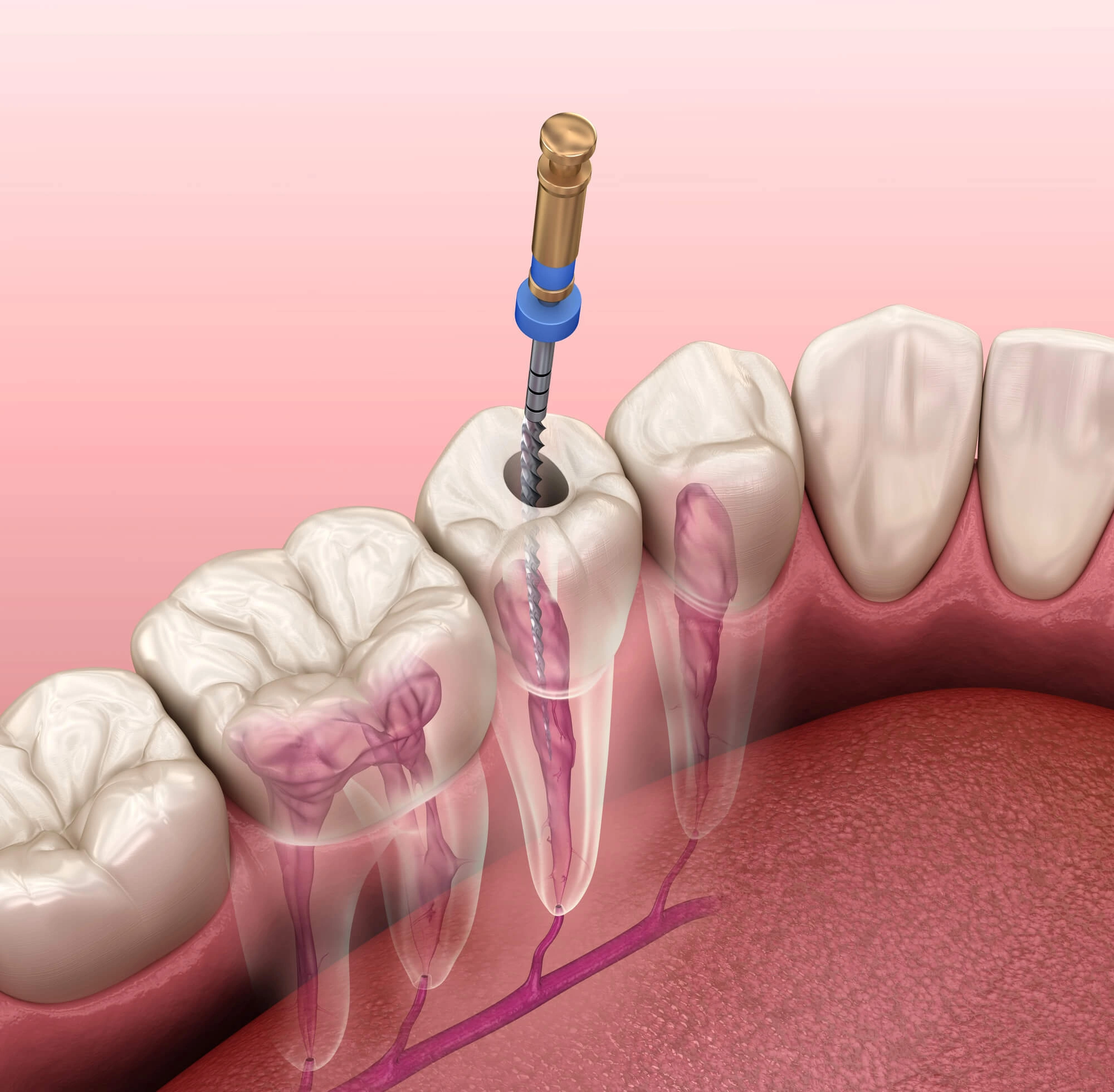 3D illustration of root canal Jupiter