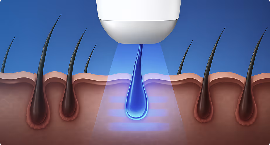 Illustration of a device emitting blue light onto a single hair follicle in skin, highlighting hair removal or treatment process.