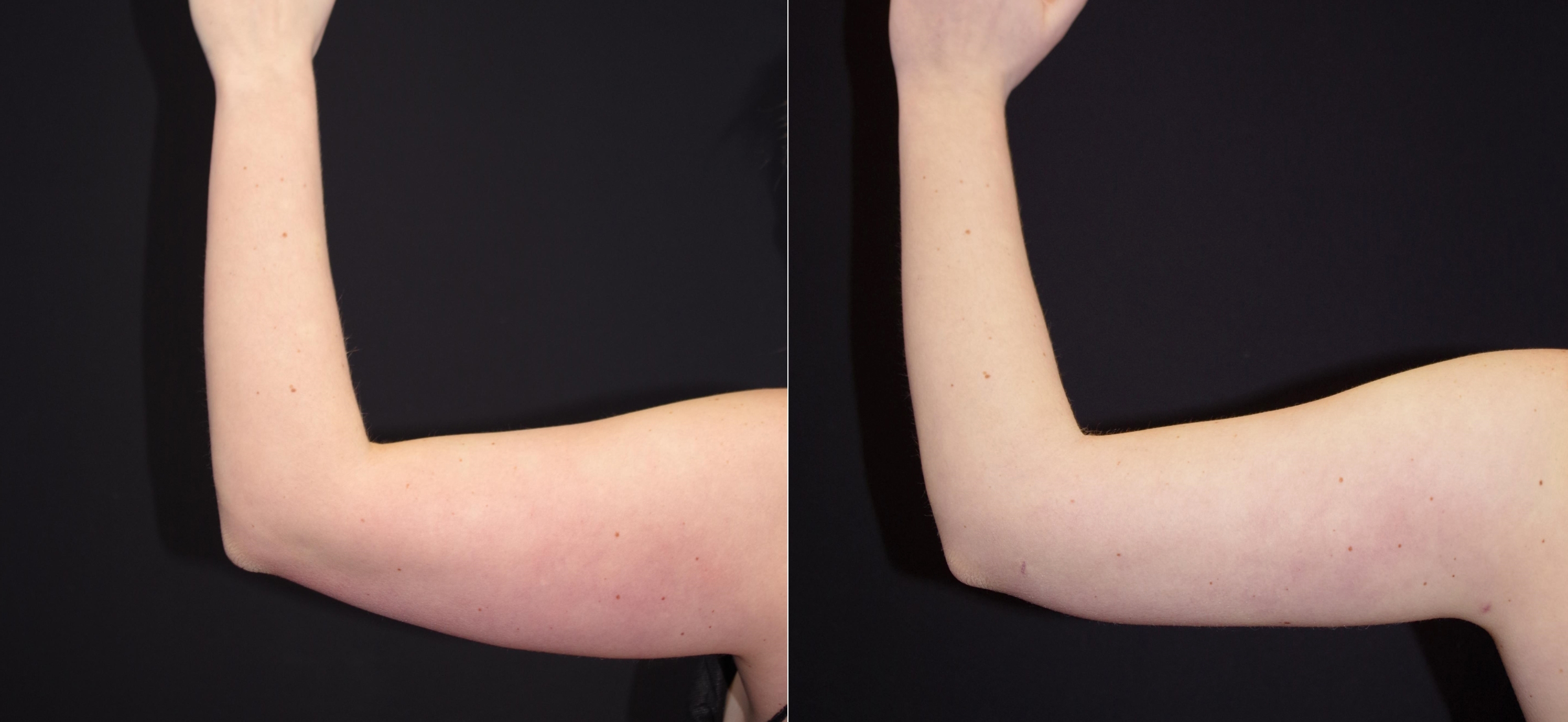 Hair Restoration Before and After