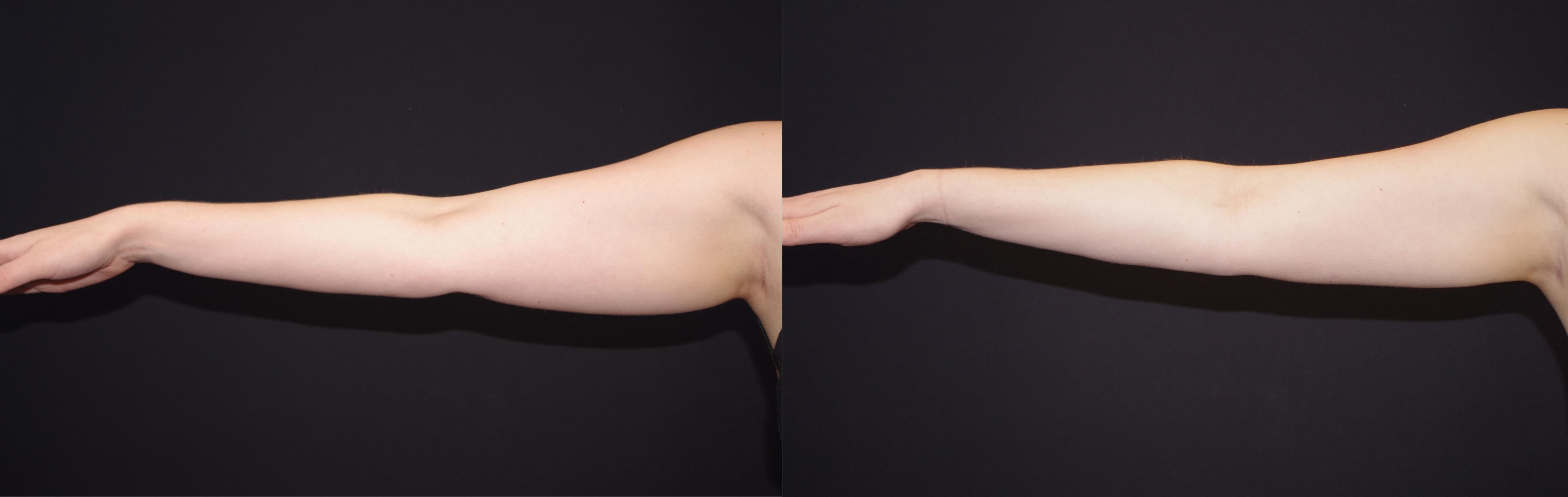 Hair Restoration Before and After