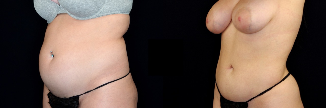 Hair Restoration Before and After