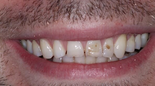 Veneers - before