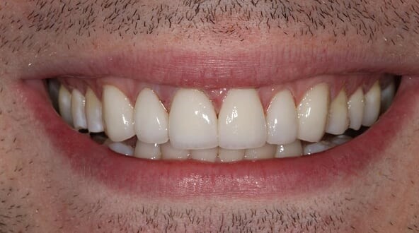 Veneers - after