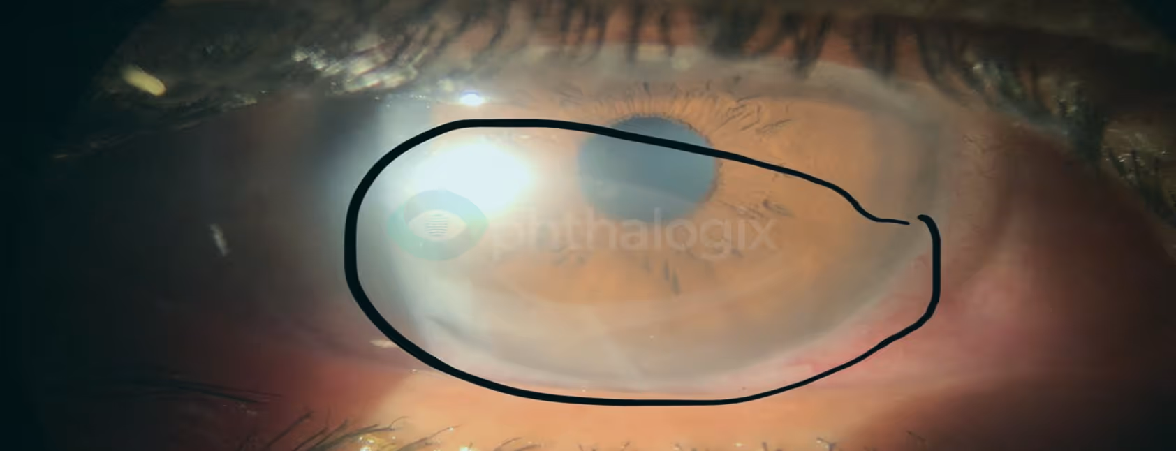 Within 24 hours — eye quiet, healing underway