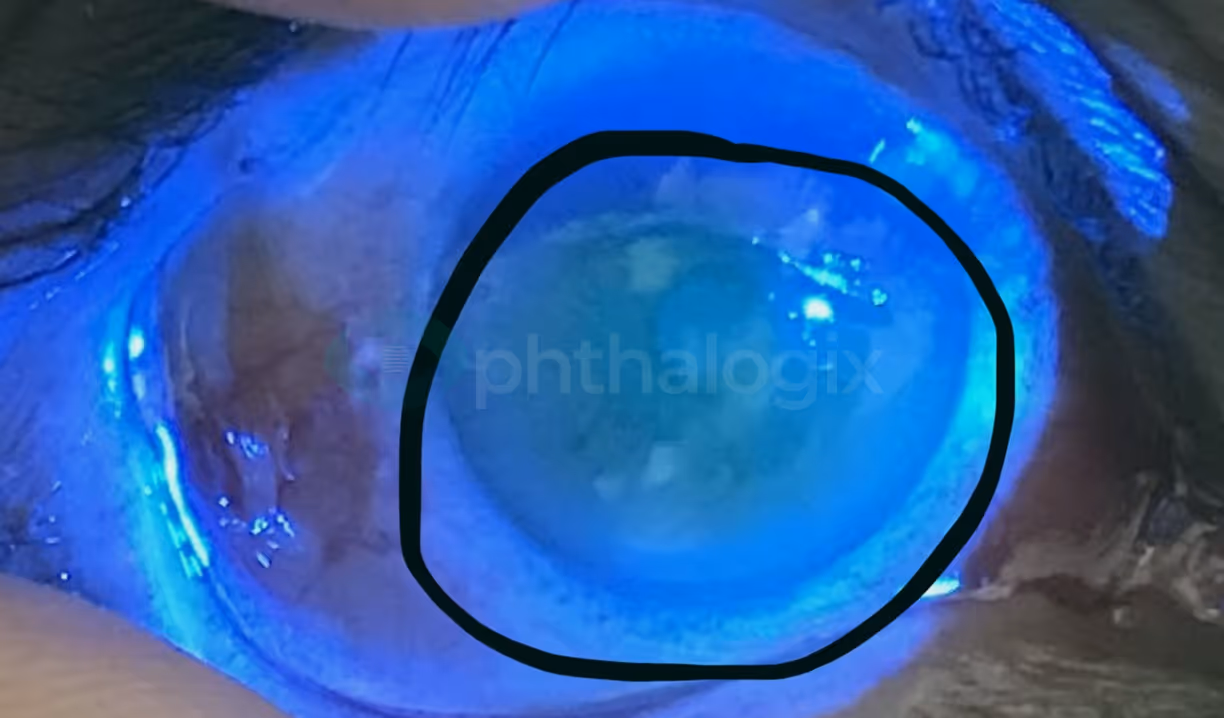 ~85% epithelial loss