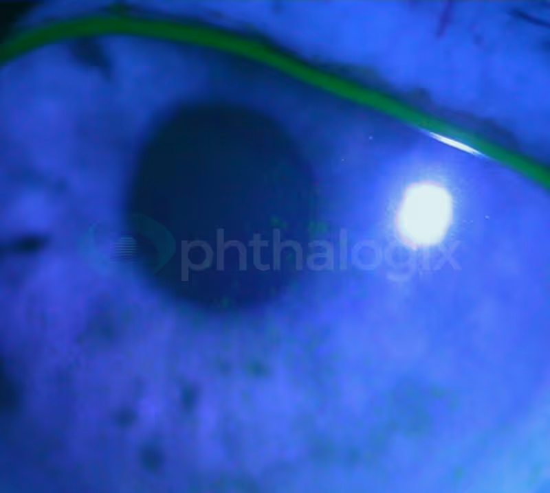 1 month after treatment OS — VA 20/20, symptoms greatly improved