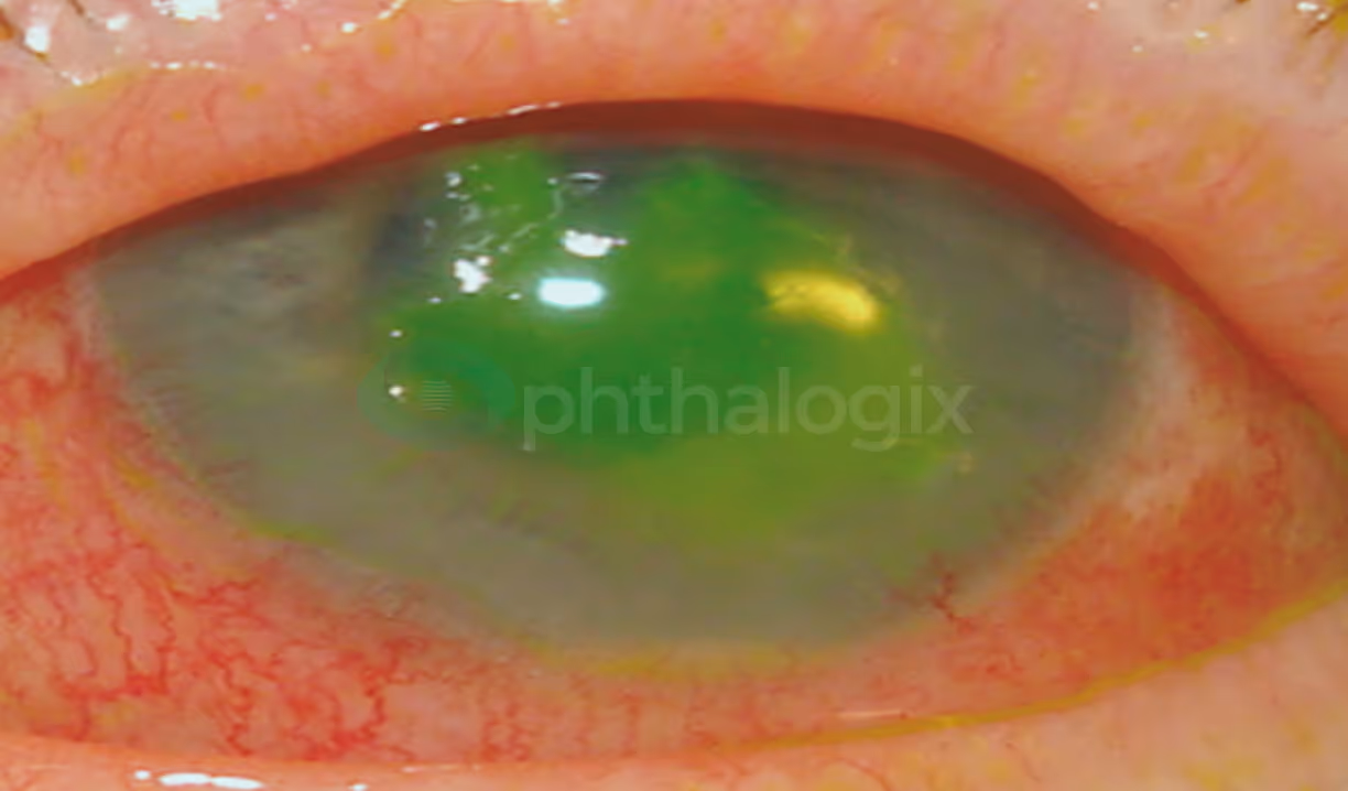 1 week after 1st treatment — VA 20/400