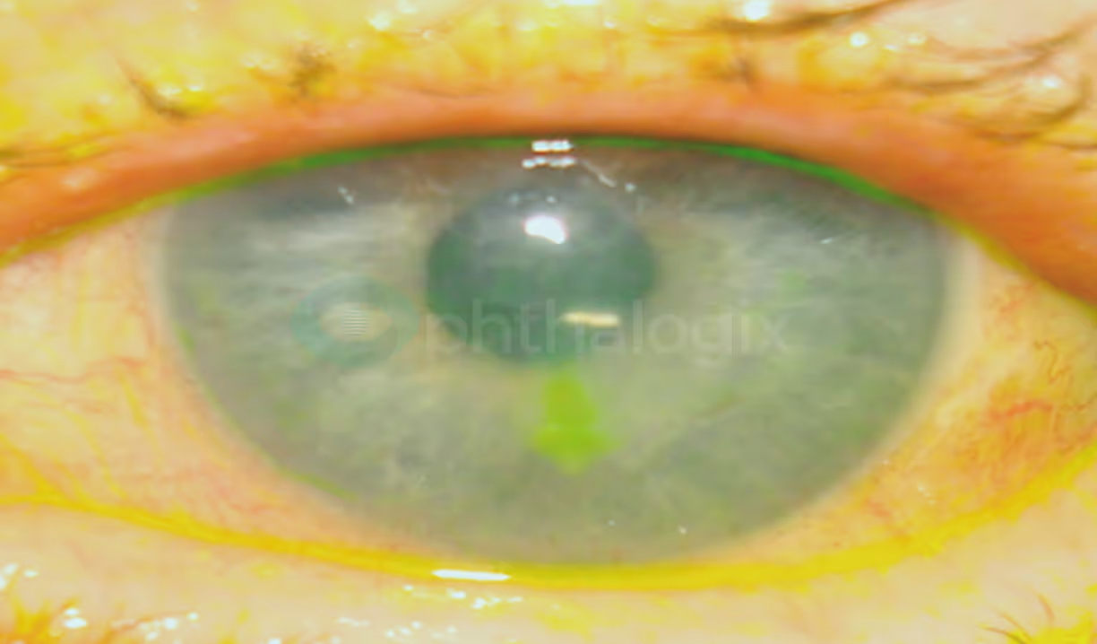 1 week after 2nd treatment — VA 20/80