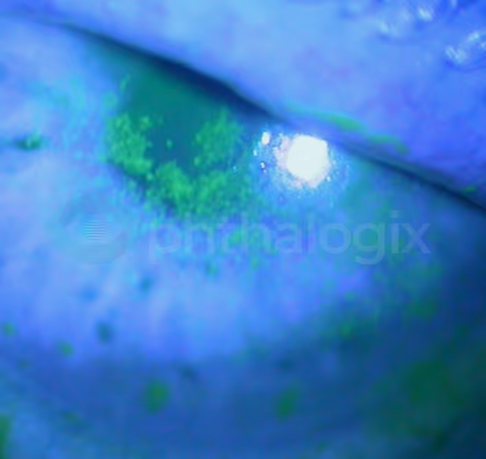 Diabetic Eye Exam