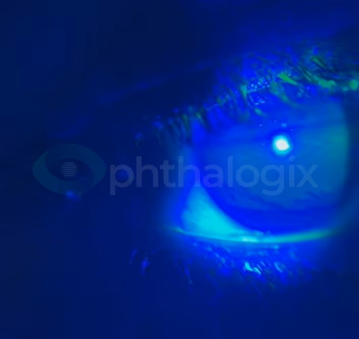 Recurrent Corneal Erosion