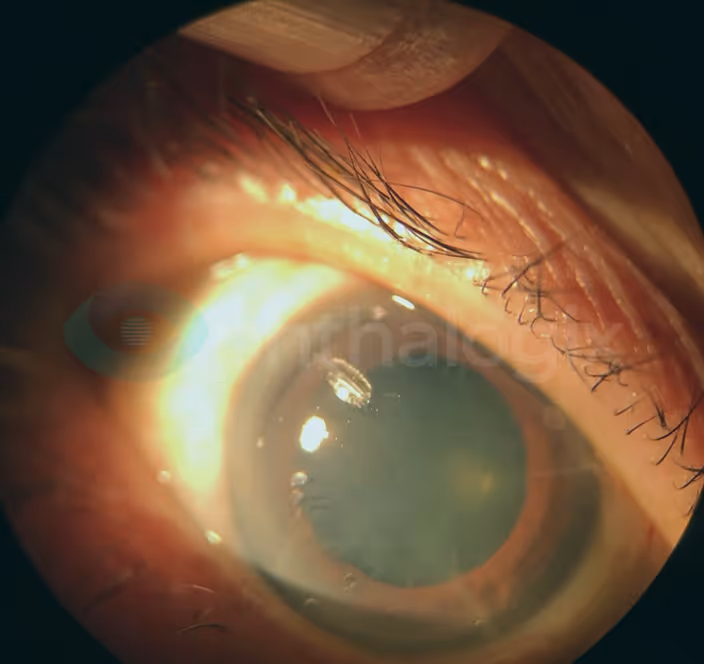 Exposure Keratopathy and Chronic Dry Eye