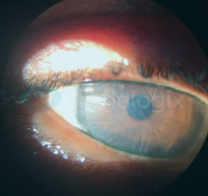 Epithelial Keratitis
