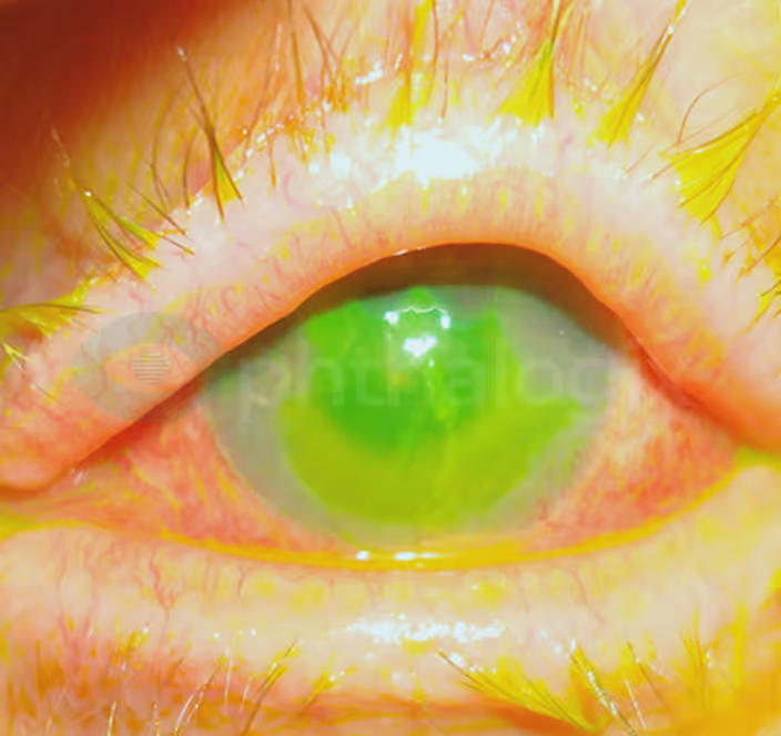 Neurotrophic Keratoconjunctivitis