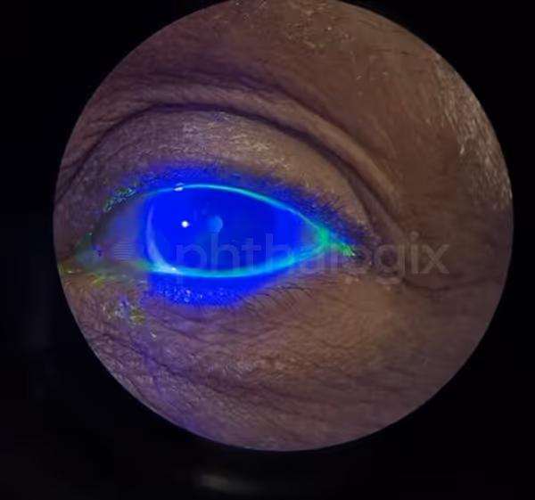 Treating Herpetic Keratitis OS with Aurora — image 6