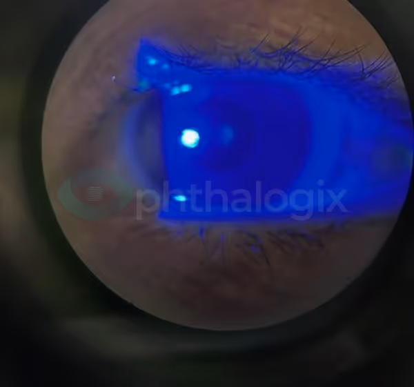 Treating Herpetic Keratitis OS with Aurora — image 4