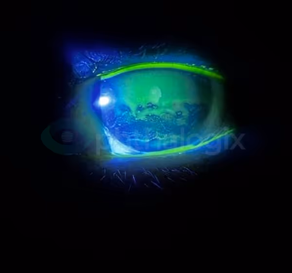 Treating Herpetic Keratitis OS with Aurora — image 2