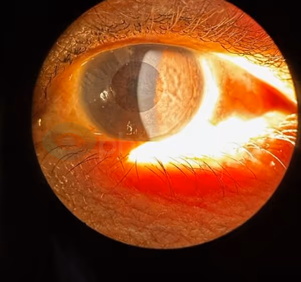 Treating Herpetic Keratitis OS with Aurora — image 3