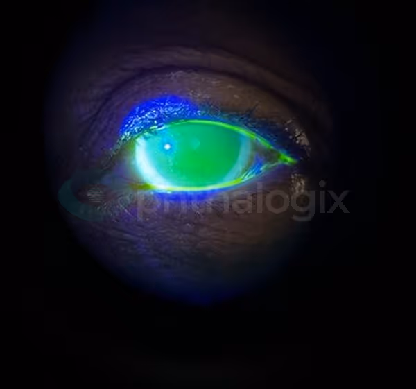 Treating Herpetic Keratitis OS with Aurora — image 7
