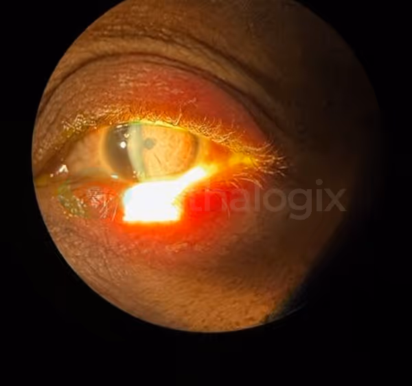 Treating Herpetic Keratitis OS with Aurora — image 5