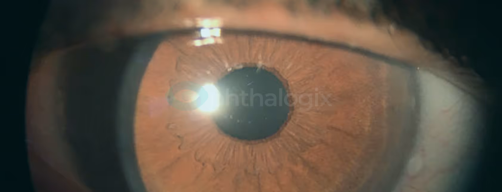 Right eye immediately after removal of soft contact lens