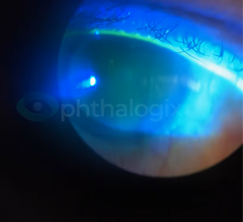 CL removed — fluorescein staining showing resolution