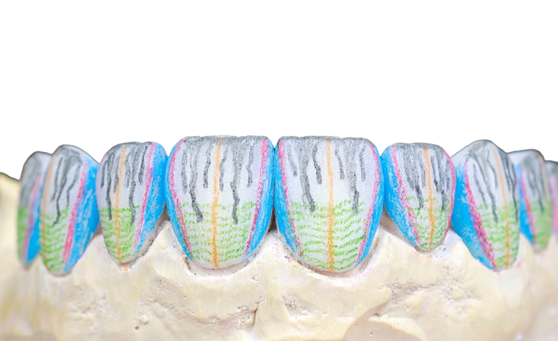 Dental model showing eight front teeth marked with colorful lines indicating enamel and dentin layers.
