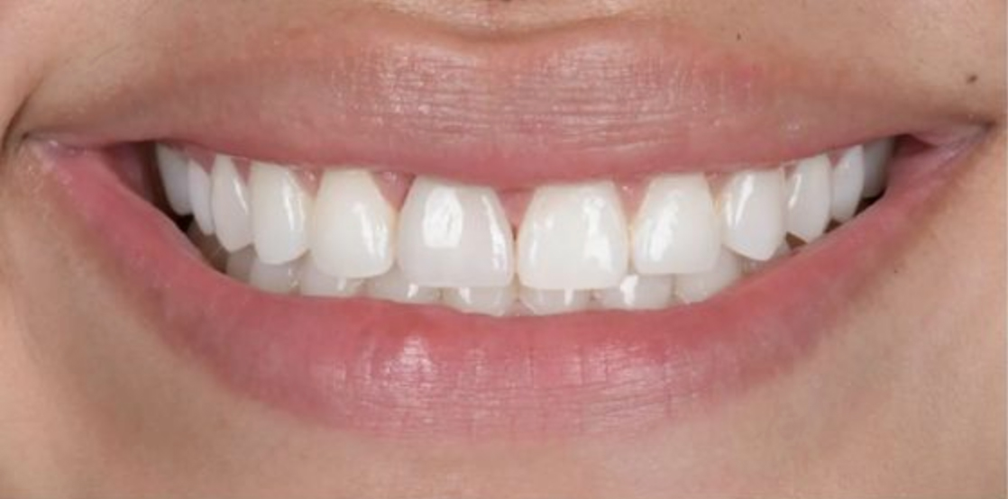 Close-up of a smiling mouth showing clean, white teeth and natural pink lips.