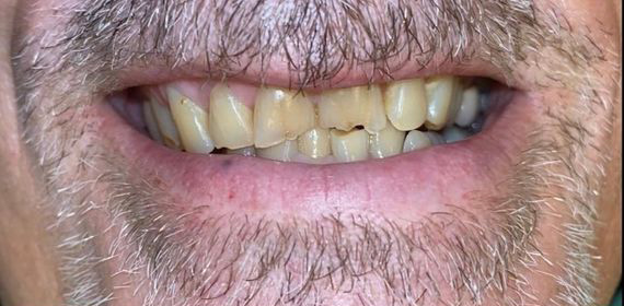 Close-up of a mouth with yellowed, chipped, and uneven teeth surrounded by a gray stubble beard.