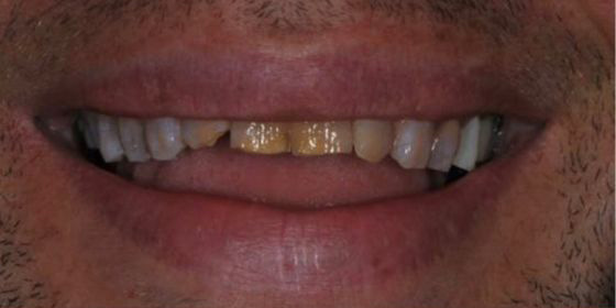 Close-up of a person's mouth showing stained and discolored upper front teeth.