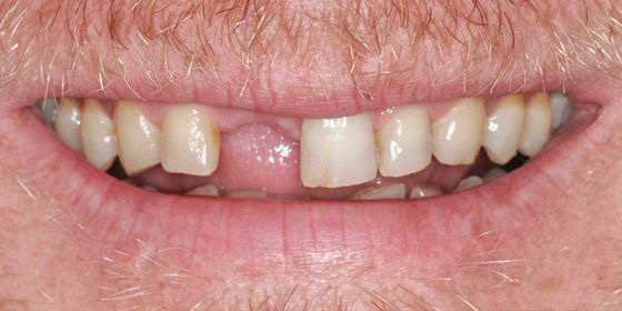 Close-up of a smile showing uneven, discolored front teeth with noticeable gaps and missing teeth.