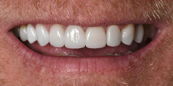 Close-up of a smiling mouth showing well-aligned, white teeth with some facial hair around the lips.