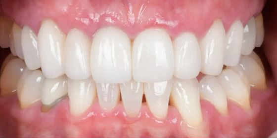 Close-up view of a person's teeth showing a dental condition with uneven and spaced lower front teeth and well-aligned upper front teeth.
