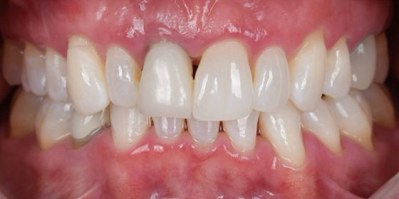 Close-up of a person's mouth showing slightly misaligned upper and lower teeth with visible gums.