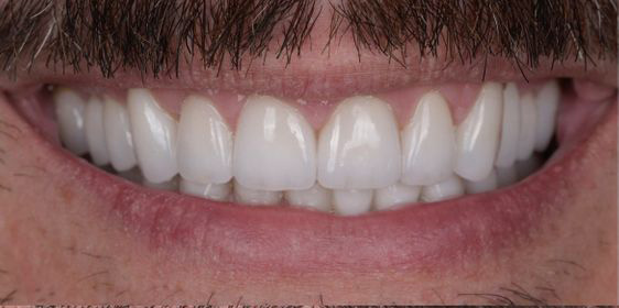Close-up of a smiling mouth showing full set of clean, white teeth and mustache above the upper lip.